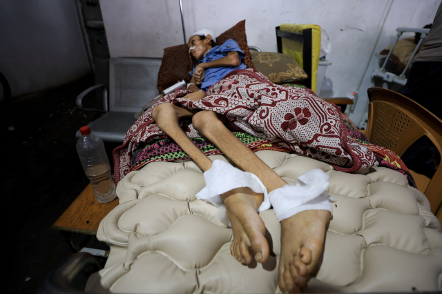 A malnourished Palestinian boy lies on a bed at Al-Shifa Hospital in Gaza City, July 22, 2025. REUTERS/Dawoud Abu Alkas